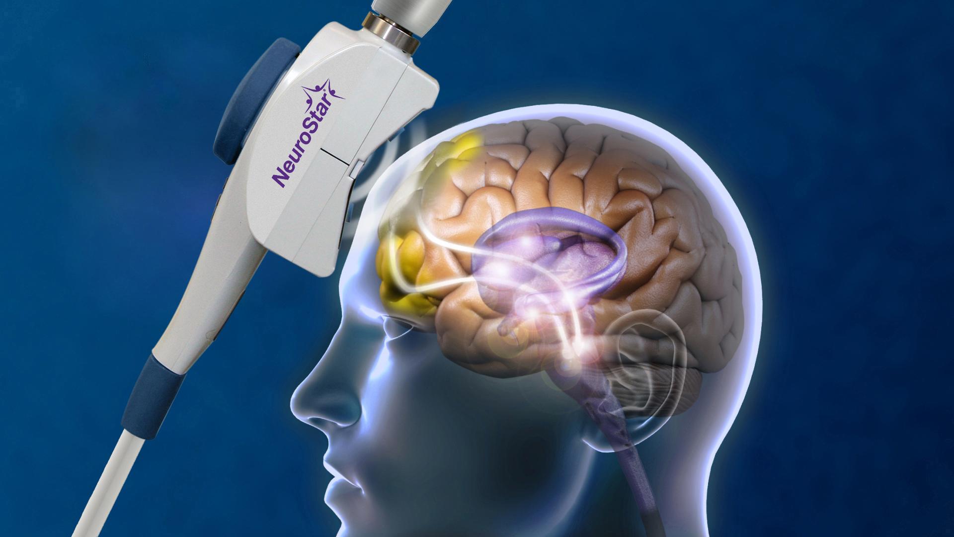 Deep TMS Vs Standard TMS For Depression Explained 5 NeuroStar coil beside a brain illustration highlighting stimulated cortical regions.